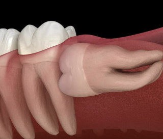 CHUYÊN GIA TƯ VẤN CÁCH KHẮC PHỤC RĂNG SỐ 8 BỊ LỢI TRÙM