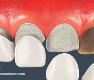 NGUYÊN NHÂN VÀ CÁCH KHẮC PHỤC RĂNG SỨ BỊ RỚT 