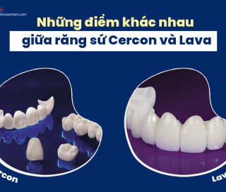 SỰ KHÁC BIỆT RĂNG SỨ CERCON VÀ LAVA? LOẠI NÀO TỐT HƠN?