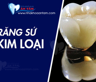 RĂNG SỨ KIM LOẠI CÓ TỐT KHÔNG?