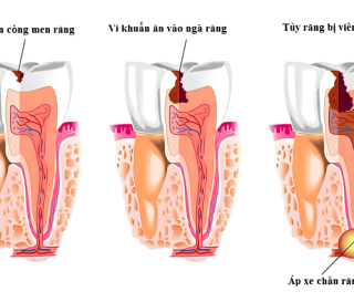 NHA KHOA BẢO TỒN - QUÁ TRÌNH SÂU RĂNG