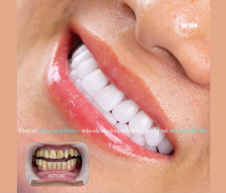 MÀI RĂNG BỌC SỨ CÓ ĐAU KHÔNG? 