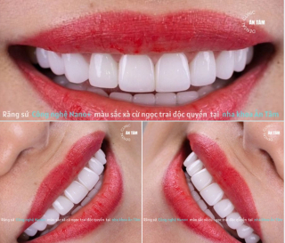 CHÍNH SÁCH VÀ ĐIỀU KIỆN BẢO HÀNH DỊCH VỤ RĂNG SỨ