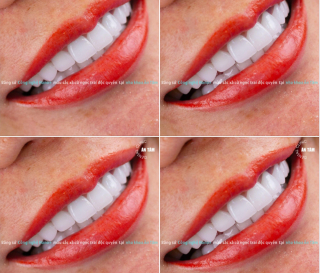 TÁC HẠI CỦA VIỆC BỌC RĂNG SỨ SAI CÁCH