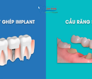 CẦU RĂNG SỨ VÀ IMPLANT PHƯƠNG PHÁP NÀO TỐT HƠN?