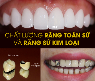 ƯU ĐIỂM NỔI BẬT RĂNG SỨ TOÀN SỨ TẠI NHA KHOA ÂN TÂM