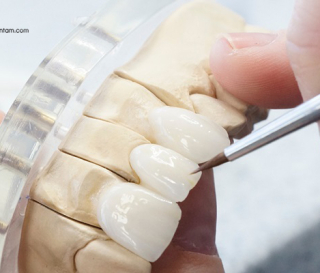 CÁC DÒNG RĂNG SỨ ĐỨC PHỔ BIẾN TẠI VIỆT NAM.
