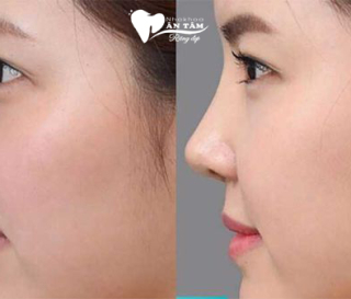 MEWING LÀ GÌ VÀ THỰC HIỆN NHƯ THẾ NÀO HIỆU QUẢ?