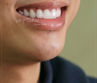 TÁC HẠI CỦA RĂNG SỨ KIM LOẠI