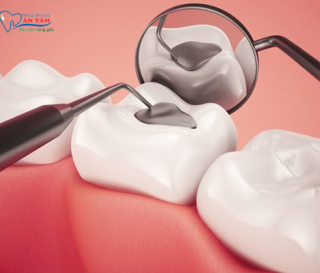 NHA KHOA BẢO TỒN - KHI NÀO CẦN TRÁM RĂNG?