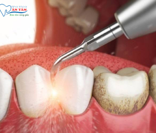 NHA KHOA BẢO TỒN - TÁC HẠI KHI LẤY CAO RĂNG SAI CÁCH