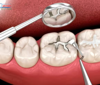 NHA KHOA BẢO TỒN - TÁC HẠI  CỦA VIỆC TRÁM RĂNG SAI KỸ THUẬT