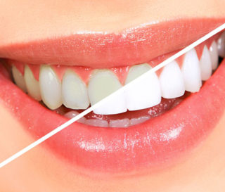 NHA KHOA BẢO TỒN - TẨY TRẮNG RĂNG HIỆU QUẢ TẠI NHA KHOA ÂN TÂM 