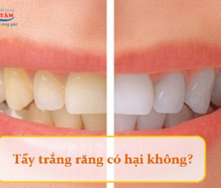 NHA KHOA BẢO TỒN - TẨY TRẮNG RĂNG CÓ HẠI KHÔNG?