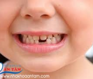 TRẺ EM CÓ ĐƯỢC BỌC RĂNG SỨ KHÔNG?