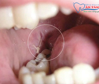 NHA KHOA BẢO TỒN - VÌ SAO XUẤT HIỆN MÀNG TRẮNG SAU KHI NHỔ RĂNG?