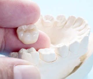 NHA KHOA BẢO TỒN - CÁC LOẠI RĂNG SỨ PHỔ BIẾN NHẤT TRÊN THỊ TRƯỜNG HIỆN NAY 