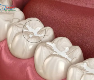 NHA KHOA BẢO TỒN - TRÁM RĂNG PHÒNG NGỪA?