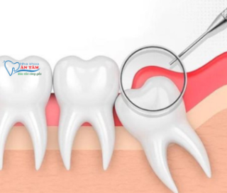 NHA KHOA BẢO TỒN - VIÊM LỢI TRÙM RĂNG KHÔN