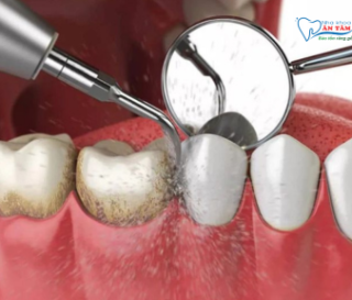 NHA KHOA BẢO TỒN - CẠO VÔI RĂNG BẰNG SÓNG SIÊU ÂM