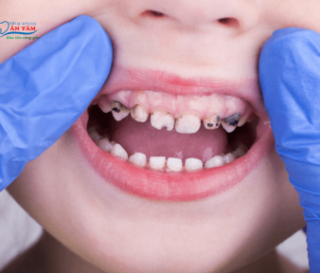NHA KHOA BẢO TỒN - XIẾT ĂN RĂNG Ở TRẺ EM