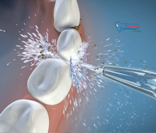 NHA KHOA BẢO TỒN - LỢI ÍCH CỦA MÁY TĂM NƯỚC