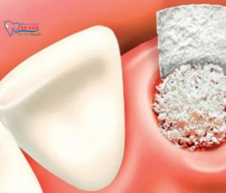 NHA KHOA BẢO TỒN - VIÊM Ổ RĂNG KHÔ LÀ GÌ?