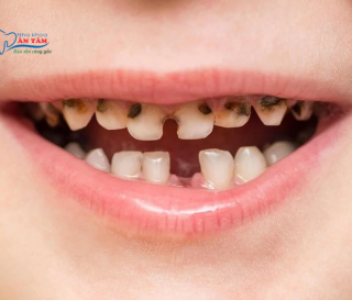 NHA KHOA BẢO TỒN - SÂU RĂNG SỮA Ở TRẺ EM