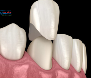 NHA KHOA BẢO TỒN - TẠI SAO NÊN BỌC SỨ SAU KHI CHỮA TỦY