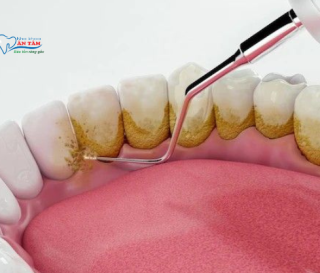NHA KHOA BẢO TỒN - VÌ SAO CẦN LẤY VÔI RĂNG ĐỊNH KỲ?