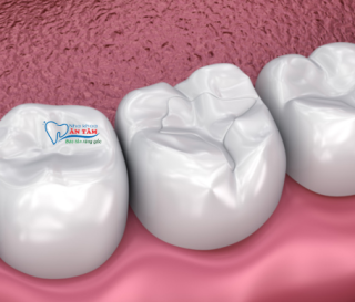 NHA KHOA BẢO TỒN - TRÁM RĂNG COMPOSITE CÓ TỐT KHÔNG?
