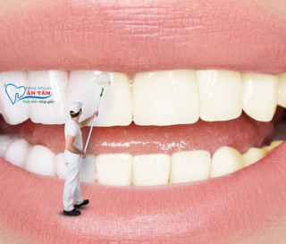 NHA KHOA BẢO TỒN - TẨY TRẮNG RĂNG GIỮ ĐƯỢC BAO LÂU?