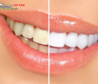 NHA KHOA BẢO TỒN TẨY TRẮNG RĂNG AN TOÀN: NHỮNG ĐIỀU BẠN CẦN BIẾT