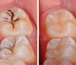 QUY TRÌNH HÀN RĂNG SÂU “CHUẨN” DIỄN RA NHƯ THẾ NÀO?