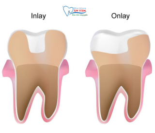 NHA KHOA BẢO TỒN - NHỮNG ĐIỀU CẦN BIẾT VỀ TRÁM INLAY/ONLAY
