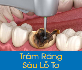 NHA KHOA BẢO TỒN - TRÁM RĂNG SÂU LỖ TO CÓ ĐƯỢC KHÔNG?