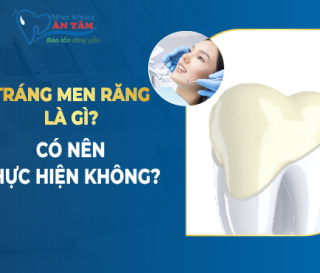 TRÁNG MEN RĂNG LÀ GÌ?