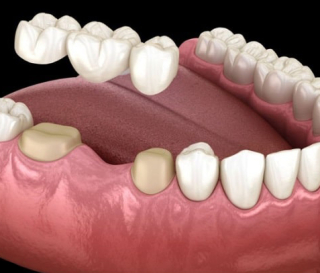 NHA KHOA BẢO TỒN - CẦU RĂNG SỨ CÓ MẤY LOẠI?