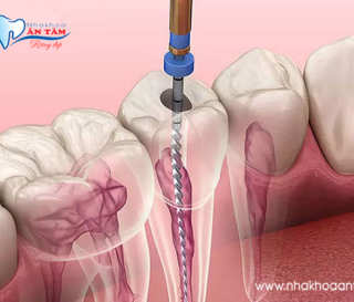 CÓ NÊN BỌC SỨ CHO RĂNG ĐÃ LẤY TỦY KHÔNG?