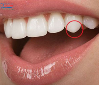 RĂNG NANH LÀ GÌ? NHỮNG ĐIỀU CẦN BIẾT VỀ RĂNG NANH