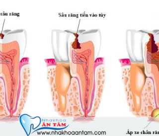 QUY TRÌNH LẤY TỦY RĂNG