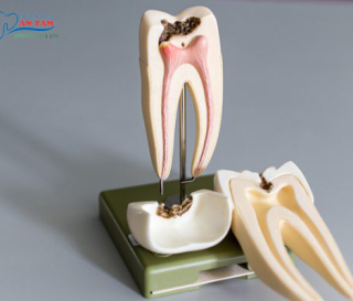 NHA KHOA BẢO TỒN - ĐIỀU TRỊ TỦY RĂNG BẢO TỒN RĂNG THẬT HIỆU QUẢ