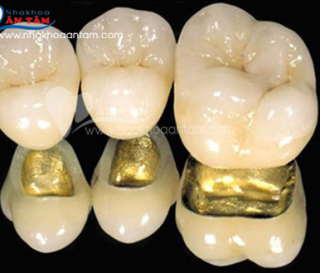 ƯU ĐIỂM CỦA RĂNG SỨ QUÝ KIM