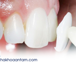 RĂNG KHÔNG ĐỀU CÓ DÁN SỨ VENEER ĐƯỢC KHÔNG?