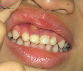 BỊ SƯNG NƯỚU CÓ MỦ THÌ PHẢI LÀM SAO?