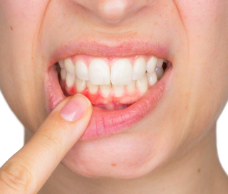 NHA KHOA BẢO TỒN - DẤU HIỆU NHẬN BIẾT VIÊM NƯỚU RĂNG
