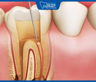 NHA KHOA BẢO TỒN - VIÊM TỦY RĂNG CÓ TỰ KHỎI KHÔNG?