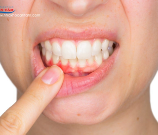 BỆNH VIÊM NHA CHU LÀ GÌ? NGUYÊN NHÂN DO ĐÂU?