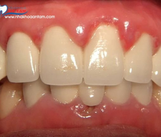 NGUYÊN NHÂN BỌC RĂNG SỨ BỊ VIÊM LỢI VÀ CÁCH KHẮC PHỤC