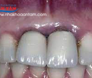 NÊN BỌC RĂNG SỨ KIM LOẠI HAY KHÔNG? VÀ CHƯƠNG TRÌNH CÓ 102 CỦA NHA KHOA ÂN TÂM